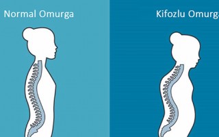 Kifoz (Kamburluk ) nedir?